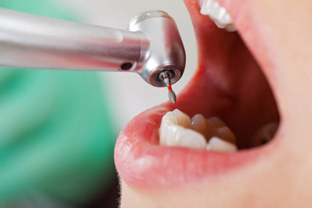 Best Knocked-Out Tooth (Avulsed Tooth) Treatment in Lake Belvedere Estates, FL